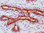 IHC image of CAC12448 diluted at 1:100 and staining in paraffin-embedded human breast cancer performed on a Leica BondTM system. After dewaxing and hydration, antigen retrieval was mediated by high pressure in a citrate buffer (pH 6.0). Section was blocked with 10% normal goat serum 30min at RT. Then primary antibody (1% BSA) was incubated at 4? overnight. The primary is detected by a biotinylated secondary antibody and visualized using an HRP conjugated SP system.