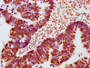 IHC image of CAC12456 diluted at 1:100 and staining in paraffin-embedded human ovarian cancer performed on a Leica BondTM system. After dewaxing and hydration, antigen retrieval was mediated by high pressure in a citrate buffer (pH 6.0). Section was blocked with 10% normal goat serum 30min at RT. Then primary antibody (1% BSA) was incubated at 4? overnight. The primary is detected by a biotinylated secondary antibody and visualized using an HRP conjugated SP system.