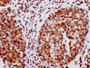 IHC image of CAC12456 diluted at 1:100 and staining in paraffin-embedded human cervical cancer performed on a Leica BondTM system. After dewaxing and hydration, antigen retrieval was mediated by high pressure in a citrate buffer (pH 6.0). Section was blocked with 10% normal goat serum 30min at RT. Then primary antibody (1% BSA) was incubated at 4? overnight. The primary is detected by a biotinylated secondary antibody and visualized using an HRP conjugated SP system.