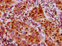 IHC image of CAC12490 diluted at 1:100 and staining in paraffin-embedded human bladder cancer performed on a Leica BondTM system. After dewaxing and hydration, antigen retrieval was mediated by high pressure in a citrate buffer (pH 6.0). Section was blocked with 10% normal goat serum 30min at RT. Then primary antibody (1% BSA) was incubated at 4? overnight. The primary is detected by a biotinylated secondary antibody and visualized using an HRP conjugated SP system.
