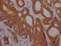 IHC image of CAC12517 diluted at 1:100 and staining in paraffin-embedded human colon cancer performed on a Leica BondTM system. After dewaxing and hydration, antigen retrieval was mediated by high pressure in a citrate buffer (pH 6.0). Section was blocked with 10% normal goat serum 30min at RT. Then primary antibody (1% BSA) was incubated at 4? overnight. The primary is detected by a Goat anti-rabbit IgG polymer labeled by HRP and visualized using 0.05% DAB.