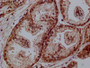 IHC image of CAC12522 diluted at 1:100 and staining in paraffin-embedded human Prostate cancer performed on a Leica BondTM system. After dewaxing and hydration, antigen retrieval was mediated by high pressure in a citrate buffer (pH 6.0). Section was blocked with 10% normal goat serum 30min at RT. Then primary antibody (1% BSA) was incubated at 4°C overnight. The primary is detected by a Goat anti-rabbit polymer IgG labeled by HRP and visualized using 0.05% DAB.