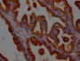 IHC image of CAC12530 diluted at 1:100 and staining in paraffin-embedded human prostate tissue performed on a Leica BondTM system. After dewaxing and hydration, antigen retrieval was mediated by high pressure in a citrate buffer (pH 6.0). Section was blocked with 10% normal goat serum 30min at RT. Then primary antibody (1% BSA) was incubated at 4? overnight. The primary is detected by a Goat anti-rabbit IgG polymer labeled by HRP and visualized using 0.05% DAB.