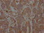IHC image of CAC12537 diluted at 1:100 and staining in paraffin-embedded human breast cancer performed on a Leica BondTM system. After dewaxing and hydration, antigen retrieval was mediated by high pressure in a citrate buffer (pH 6.0). Section was blocked with 10% normal goat serum 30min at RT. Then primary antibody (1% BSA) was incubated at 4? overnight. The primary is detected by a Goat anti-rabbit IgG polymer labeled by HRP and visualized using 0.05% DAB.