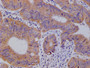 IHC image of CAC12585 diluted at 1:100 and staining in paraffin-embedded human colon cancer performed on a Leica BondTM system. After dewaxing and hydration, antigen retrieval was mediated by high pressure in a citrate buffer (pH 6.0). Section was blocked with 10% normal goat serum 30min at RT. Then primary antibody (1% BSA) was incubated at 4°C overnight. The primary is detected by a Goat anti-rabbit polymer IgG labeled by HRP and visualized using 0.05% DAB.