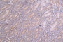 IHC image of CAC12594 diluted at 1:100 and staining in paraffin-embedded human breast cancer performed on a Leica BondTM system. After dewaxing and hydration, antigen retrieval was mediated by high pressure in a citrate buffer (pH 6.0). Section was blocked with 10% normal goat serum 30min at RT. Then primary antibody (1% BSA) was incubated at 4°C overnight. The primary is detected by a Goat anti-rabbit polymer IgG labeled by HRP and visualized using 0.69% DAB.