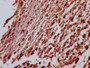 IHC image of CAC12598 diluted at 1:100 and staining in paraffin-embedded human melanoma cancer performed on a Leica BondTM system. After dewaxing and hydration, antigen retrieval was mediated by high pressure in a citrate buffer (pH 6.0). Section was blocked with 10% normal goat serum 30min at RT. Then primary antibody (1% BSA) was incubated at 4? overnight. The primary is detected by a Goat anti-rabbit IgG polymer labeled by HRP and visualized using 0.05% DAB.