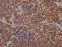 IHC image of CAC12604 diluted at 1:100 and staining in paraffin-embedded human lung cancer performed on a Leica BondTM system. After dewaxing and hydration, antigen retrieval was mediated by high pressure in a citrate buffer (pH 6.0). Section was blocked with 10% normal goat serum 30min at RT. Then primary antibody (1% BSA) was incubated at 4? overnight. The primary is detected by a Goat anti-rabbit IgG polymer labeled by HRP and visualized using 0.05% DAB.