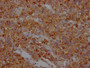 IHC image of CAC12615 diluted at 1:100 and staining in paraffin-embedded human glioma cancer performed on a Leica BondTM system. After dewaxing and hydration, antigen retrieval was mediated by high pressure in a citrate buffer (pH 6.0). Section was blocked with 10% normal goat serum 30min at RT. Then primary antibody (1% BSA) was incubated at 4? overnight. The primary is detected by a Goat anti-rabbit IgG polymer labeled by HRP and visualized using 0.05% DAB.