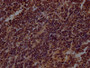 IHC image of CAC12620 diluted at 1:100 and staining in paraffin-embedded human lung cancer performed on a Leica BondTM system. After dewaxing and hydration, antigen retrieval was mediated by high pressure in a citrate buffer (pH 6.0). Section was blocked with 10% normal goat serum 30min at RT. Then primary antibody (1% BSA) was incubated at 4? overnight. The primary is detected by a Goat anti-rabbit IgG polymer labeled by HRP and visualized using 0.05% DAB.