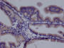 IHC image of CAC12631 diluted at 1:100 and staining in paraffin-embedded human prostate tissue performed on a Leica BondTM system. After dewaxing and hydration, antigen retrieval was mediated by high pressure in a citrate buffer (pH 6.0). Section was blocked with 10% normal goat serum 30min at RT. Then primary antibody (1% BSA) was incubated at 4°C overnight. The primary is detected by a Goat anti-rabbit polymer IgG labeled by HRP and visualized using 0.05% DAB.