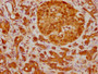 IHC image of CAC12635 diluted at 1:210 and staining in paraffin-embedded human pancreatic cancer performed on a Leica BondTM system. After dewaxing and hydration, antigen retrieval was mediated by high pressure in a citrate buffer (pH 6.0). Section was blocked with 10% normal goat serum 30min at RT. Then primary antibody (1% BSA) was incubated at 4? overnight. The primary is detected by a biotinylated secondary antibody and visualized using an HRP conjugated SP system.