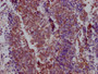 IHC image of CAC12642 diluted at 1:100 and staining in paraffin-embedded human lung cancer performed on a Leica BondTM system. After dewaxing and hydration, antigen retrieval was mediated by high pressure in a citrate buffer (pH 6.0). Section was blocked with 10% normal goat serum 30min at RT. Then primary antibody (1% BSA) was incubated at 4? overnight. The primary is detected by a Goat anti-rabbit IgG polymer labeled by HRP and visualized using 0.05% DAB.