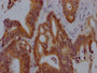 IHC image of CAC12654 diluted at 1:100 and staining in paraffin-embedded human colon cancer performed on a Leica BondTM system. After dewaxing and hydration, antigen retrieval was mediated by high pressure in a citrate buffer (pH 6.0). Section was blocked with 10% normal goat serum 30min at RT. Then primary antibody (1% BSA) was incubated at 4? overnight. The primary is detected by a Goat anti-rabbit IgG polymer labeled by HRP and visualized using 0.05% DAB.