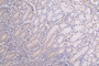 IHC image diluted at 1:50 and staining in paraffin-embedded human breast cancer performed on a Leica BondTM system. After dewaxing and hydration, antigen retrieval was mediated by high pressure in a citrate buffer (pH 6.0). Section was blocked with 10% normal goat serum 30min at RT. Then primary antibody (1% BSA) was incubated at 4°C overnight. The primary is detected by a Goat anti-rabbit polymer IgG labeled by HRP and visualized using 0.60% DAB.