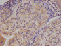 IHC image of CAC12660 diluted at 1:100 and staining in paraffin-embedded human endometrial cancer performed on a Leica BondTM system. After dewaxing and hydration, antigen retrieval was mediated by high pressure in a citrate buffer (pH 6.0). Section was blocked with 10% normal goat serum 30min at RT. Then primary antibody (1% BSA) was incubated at 4°C overnight. The primary is detected by a Goat anti-rabbit polymer IgG labeled by HRP and visualized using 0.05% DAB.