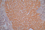 IHC image of CAC12669 diluted at 1:30 and staining in paraffin-embedded human liver cancer performed on a Leica BondTM system. After dewaxing and hydration, antigen retrieval was mediated by high pressure in a citrate buffer (pH 6.0). Section was blocked with 10% normal goat serum 30min at RT. Then primary antibody (1% BSA) was incubated at 4°C overnight. The primary is detected by a Goat anti-Mouse IgG labeled by HRP and visualized using 0.05% DAB.