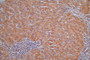 IHC image of CAC12703 diluted at 1:30 and staining in paraffin-embedded human liver cancer performed on a Leica BondTM system. After dewaxing and hydration, antigen retrieval was mediated by high pressure in a citrate buffer (pH 6.0). Section was blocked with 10% normal goat serum 30min at RT. Then primary antibody (1% BSA) was incubated at 4°C overnight. The primary is detected by a Goat anti-Mouse IgG labeled by HRP and visualized using 0.05% DAB.