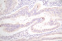 IHC image of CAC12711 diluted at 1:100 and staining in paraffin-embedded human endometrial cancer performed on a Leica BondTM system. After dewaxing and hydration, antigen retrieval was mediated by high pressure in a citrate buffer (pH 6.0). Section was blocked with 10% normal goat serum 30min at RT. Then primary antibody (1% BSA) was incubated at 4°C overnight. The primary is detected by a Goat anti-Mouse IgG labeled by HRP and visualized using 0.05% DAB.