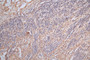 IHC image of CAC12720 diluted at 1:300 and staining in paraffin-embedded human glioma cancer performed on a Leica BondTM system. After dewaxing and hydration, antigen retrieval was mediated by high pressure in a citrate buffer (pH 6.0). Section was blocked with 10% normal goat serum 30min at RT. Then primary antibody (1% BSA) was incubated at 4°C overnight. The primary is detected by a Goat anti-Mouse IgG labeled by HRP and visualized using 0.05% DAB.