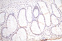 IHC image of CAC12760 diluted at 1:300 and staining in paraffin-embedded human colorectal cancer performed on a Leica BondTM system. After dewaxing and hydration, antigen retrieval was mediated by high pressure in a citrate buffer (pH 6.0). Section was blocked with 10% normal goat serum 30min at RT. Then primary antibody (1% BSA) was incubated at 4°C overnight. The primary is detected by a Goat anti-Mouse IgG labeled by HRP and visualized using 0.05% DAB.