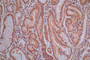 IHC image of CAC12768 diluted at 1:30 and staining in paraffin-embedded human gastric cancer performed on a Leica BondTM system. After dewaxing and hydration, antigen retrieval was mediated by high pressure in a citrate buffer (pH 6.0). Section was blocked with 10% normal goat serum 30min at RT. Then primary antibody (1% BSA) was incubated at 4°C overnight. The primary is detected by a Goat anti-Mouse IgG labeled by HRP and visualized using 0.05% DAB.