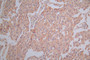 IHC image of CAC12771 diluted at 1:200 and staining in paraffin-embedded human lung cancer performed on a Leica BondTM system. After dewaxing and hydration, antigen retrieval was mediated by high pressure in a citrate buffer (pH 6.0). Section was blocked with 10% normal goat serum 30min at RT. Then primary antibody (1% BSA) was incubated at 4°C overnight. The primary is detected by a Goat anti-Mouse IgG labeled by HRP and visualized using 0.05% DAB.