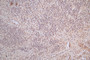 IHC image of CAC12774 diluted at 1:100 and staining in paraffin-embedded human glioma cancer performed on a Leica BondTM system. After dewaxing and hydration, antigen retrieval was mediated by high pressure in a citrate buffer (pH 6.0). Section was blocked with 10% normal goat serum 30min at RT. Then primary antibody (1% BSA) was incubated at 4°C overnight. The primary is detected by a Goat anti-Mouse IgG labeled by HRP and visualized using 0.05% DAB.