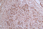 IHC image of CAC12792 diluted at 1:300 and staining in paraffin-embedded human pancreatic cancer performed on a Leica BondTM system. After dewaxing and hydration, antigen retrieval was mediated by high pressure in a citrate buffer (pH 6.0). Section was blocked with 10% normal goat serum 30min at RT. Then primary antibody (1% BSA) was incubated at 4°C overnight. The primary is detected by a Goat anti-Mouse IgG labeled by HRP and visualized using 0.05% DAB.