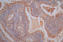 IHC image of CAC12796 diluted at 1:40 and staining in paraffin-embedded human endometrial cancer performed on a Leica BondTM system. After dewaxing and hydration, antigen retrieval was mediated by high pressure in a citrate buffer (pH 6.0). Section was blocked with 10% normal goat serum 30min at RT. Then primary antibody (1% BSA) was incubated at 4°C overnight. The primary is detected by a Goat anti-Rabbit IgG labeled by HRP and visualized using 0.05% DAB.