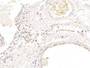 DAB staining on IHC-P; Samples: Human Mammary gland Tissue; Primary Ab: 10µg/ml Rabbit Anti-Human PIP Antibody Second Ab: 2µg/mL HRP-Linked Caprine Anti-Rabbit IgG Polyclonal Antibody