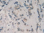 Figure. DAB staining on IHC-P; Samples：Human Breast Cancer Tissue.