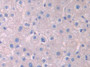 DAB staining on IHC-P; Samples: Human Liver Tissue; Primary Ab: 30µg/ml Rabbit Anti-Human LCAT Antibody Second Ab: 2µg/mL HRP-Linked Caprine Anti-Rabbit IgG Polyclonal Antibody DAB staining on IHC-P; Samples: Human Liver Tissue; Primary Ab: 30µg/ml Rabbit Anti-Human LCAT Antibody Second Ab: 2µg/mL HRP-Linked Caprine Anti-Rabbit IgG Polyclonal Antibody