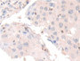 DAB staining on IHC-P; Samples: Human Breast cancer Tissue; Primary Ab: 30µg/ml Rabbit Anti-Human COTL1 Antibody Second Ab: 2µg/mL HRP-Linked Caprine Anti-Rabbit IgG Polyclonal Antibody DAB staining on IHC-P; Samples: Human Breast cancer Tissue; Primary Ab: 30µg/ml Rabbit Anti-Human COTL1 Antibody Second Ab: 2µg/mL HRP-Linked Caprine Anti-Rabbit IgG Polyclonal Antibody