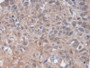 DAB staining on IHC-P; Samples: Human Lung cancer Tissue DAB staining on IHC-P; Samples: Human Lung cancer Tissue