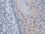DAB staining on IHC-P; Samples: Human Skin cancer Tissue; Primary Ab: 10µg/ml Rabbit Anti-Human IREB2 Antibody Second Ab: 2µg/mL HRP-Linked Caprine Anti-Rabbit IgG Polyclonal Antibody DAB staining on IHC-P; Samples: Human Skin cancer Tissue; Primary Ab: 10µg/ml Rabbit Anti-Human IREB2 Antibody Second Ab: 2µg/mL HRP-Linked Caprine Anti-Rabbit IgG Polyclonal Antibody