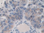 DAB staining on IHC-P; Samples: Human Breast cancer Tissue; Primary Ab: 10µg/ml Rabbit Anti-Human ITIH1 Antibody Second Ab: 2µg/mL HRP-Linked Caprine Anti-Rabbit IgG Polyclonal Antibody DAB staining on IHC-P; Samples: Human Breast cancer Tissue; Primary Ab: 10µg/ml Rabbit Anti-Human ITIH1 Antibody Second Ab: 2µg/mL HRP-Linked Caprine Anti-Rabbit IgG Polyclonal Antibody