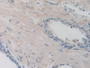 DAB staining on IHC-P; Samples: Human Prostate Gland Tissue. DAB staining on IHC-P; Samples: Human Prostate Gland Tissue.