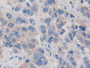 DAB staining on IHC-P; Samples: Human Breast cancer Tissue; Primary Ab: 10µg/ml Rabbit Anti-Human PDHX Antibody Second Ab: 2µg/mL HRP-Linked Caprine Anti-Rabbit IgG Polyclonal Antibody DAB staining on IHC-P; Samples: Human Breast cancer Tissue; Primary Ab: 10µg/ml Rabbit Anti-Human PDHX Antibody Second Ab: 2µg/mL HRP-Linked Caprine Anti-Rabbit IgG Polyclonal Antibody