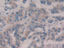 DAB staining on IHC-P; Samples: Human Breast cancer Tissue;  Primary Ab: 10µg/ml Rabbit Anti-Human W DAB staining on IHC-P; Samples: Human Breast cancer Tissue;  Primary Ab: 10µg/ml Rabbit Anti-Human W