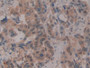 DAB staining on IHC-P; Samples: Human Breast cancer Tissue; Primary Ab: 10µg/ml Rabbit Anti-Human CIRBP Antibody Second Ab: 2µg/mL HRP-Linked Caprine Anti-Rabbit IgG Polyclonal Antibody DAB staining on IHC-P; Samples: Human Breast cancer Tissue; Primary Ab: 10µg/ml Rabbit Anti-Human CIRBP Antibody Second Ab: 2µg/mL HRP-Linked Caprine Anti-Rabbit IgG Polyclonal Antibody