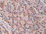 DAB staining on IHC-P; Samples: Human Liver cancer Tissue; Primary Ab: 25µg/ml Rabbit Anti-Human SEPT5 Antibody Second Ab: 2µg/mL HRP-Linked Caprine Anti-Rabbit IgG Polyclonal Antibody DAB staining on IHC-P; Samples: Human Liver cancer Tissue; Primary Ab: 25µg/ml Rabbit Anti-Human SEPT5 Antibody Second Ab: 2µg/mL HRP-Linked Caprine Anti-Rabbit IgG Polyclonal Antibody