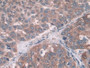 DAB staining on IHC-P; Samples: Human Liver cancer Tissue; Primary Ab: 10µg/ml Rabbit Anti-Human FUT6 Antibody Second Ab: 2µg/mL HRP-Linked Caprine Anti-Rabbit IgG Polyclonal Antibody DAB staining on IHC-P; Samples: Human Liver cancer Tissue; Primary Ab: 10µg/ml Rabbit Anti-Human FUT6 Antibody Second Ab: 2µg/mL HRP-Linked Caprine Anti-Rabbit IgG Polyclonal Antibody