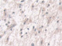 DAB staining on IHC-P; Samples: Human Glioma Tissue; Primary Ab: 10µg/ml Rabbit Anti-Human FUT6 Antibody Second Ab: 2µg/mL HRP-Linked Caprine Anti-Rabbit IgG Polyclonal Antibody DAB staining on IHC-P; Samples: Human Glioma Tissue; Primary Ab: 10µg/ml Rabbit Anti-Human FUT6 Antibody Second Ab: 2µg/mL HRP-Linked Caprine Anti-Rabbit IgG Polyclonal Antibody