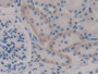 DAB staining on IHC-P; Samples: Mouse Kidney Tissue; Primary Ab: 10µg/ml Rabbit Anti-Mouse IkBe Antibody Second Ab: 2µg/mL HRP-Linked Caprine Anti-Rabbit IgG Polyclonal Antibody DAB staining on IHC-P; Samples: Mouse Kidney Tissue; Primary Ab: 10µg/ml Rabbit Anti-Mouse IkBe Antibody Second Ab: 2µg/mL HRP-Linked Caprine Anti-Rabbit IgG Polyclonal Antibody