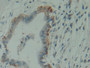 DAB staining on IHC-P; Samples: Human Pancreas cancer Tissue;  Primary Ab: 10µg/ml Rabbit Anti-Human DAB staining on IHC-P; Samples: Human Pancreas cancer Tissue;  Primary Ab: 10µg/ml Rabbit Anti-Human