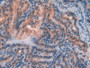 DAB staining on IHC-P; Samples: Human Thyroid cancer Tissue) DAB staining on IHC-P; Samples: Human Thyroid cancer Tissue)