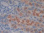 DAB staining on IHC-P; Samples: Human Stomach cancer Tissue)