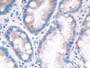 DAB staining on IHC-P; Samples: Human Stomach cancer Tissue; Primary Ab: 30µg/ml Rabbit Anti-Human LRP4 Antibody Second Ab: 2µg/mL HRP-Linked Caprine Anti-Rabbit IgG Polyclonal Antibody DAB staining on IHC-P; Samples: Human Stomach cancer Tissue; Primary Ab: 30µg/ml Rabbit Anti-Human LRP4 Antibody Second Ab: 2µg/mL HRP-Linked Caprine Anti-Rabbit IgG Polyclonal Antibody