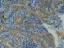 DAB staining on IHC-P; Samples: Human Thyroid cancer Tissue; Primary Ab: 20µg/ml Rabbit Anti-Human HSP90aA1 Antibody Second Ab: 2µg/mL HRP-Linked Caprine Anti-Rabbit IgG Polyclonal Antibody DAB staining on IHC-P; Samples: Human Thyroid cancer Tissue; Primary Ab: 20µg/ml Rabbit Anti-Human HSP90aA1 Antibody Second Ab: 2µg/mL HRP-Linked Caprine Anti-Rabbit IgG Polyclonal Antibody